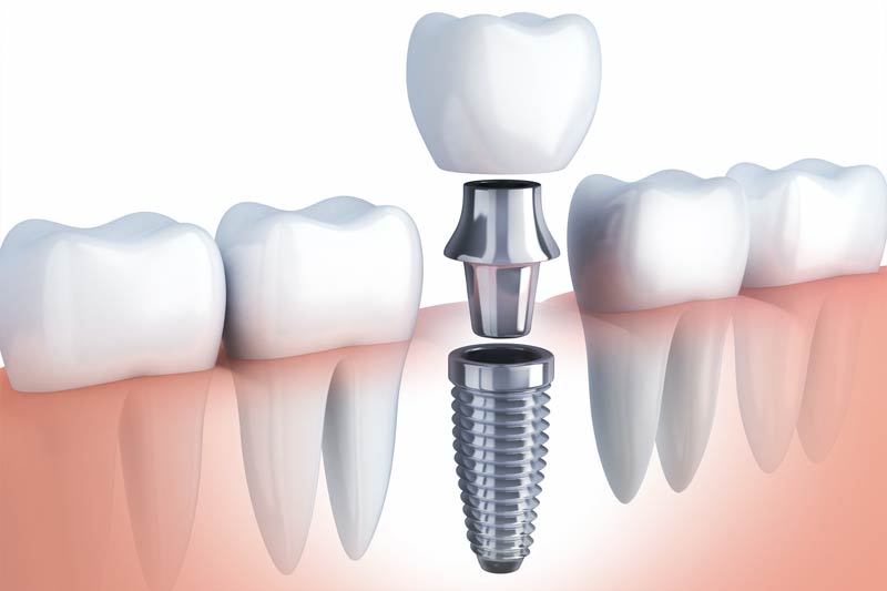 Dental Implants in Playa Del Rey