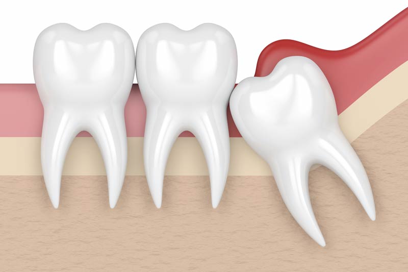 Extractions in Playa Del Rey